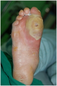 중증의 당뇨병성신경병증으로 이물질이 발에 박혀 있는 것을 알지 못해 발바닥에 광범위한 염증과 감염이 발생한 당뇨환자의 발.